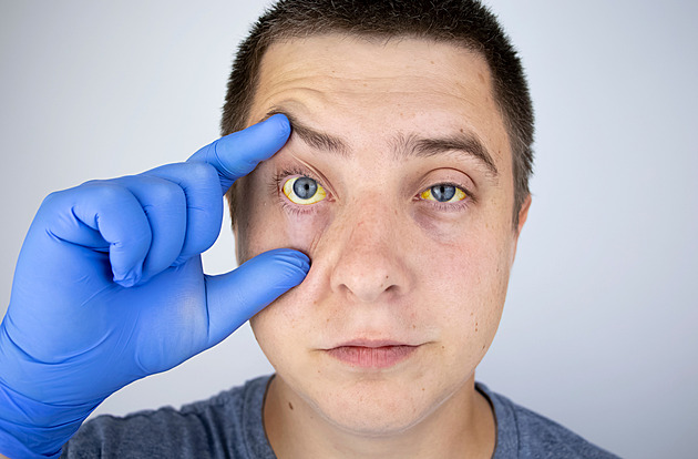 Žloutenka v Česku sílí, zájemce o očkování však lékaři musejí odmítat. Vakcíny došly